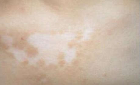 白癜风患者的皮肤应该怎么护理