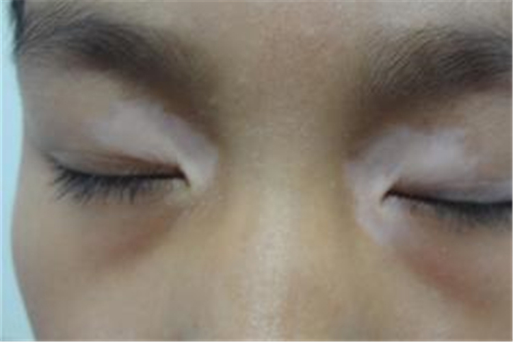 眼睛部位有白斑对眼睛会有影响吗