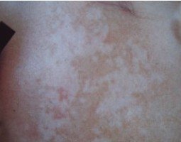 °×ñ°·ç±È½Ï·ÖÉ¢Ó¦¸ÃÔõôÖÎÁÆÄØ